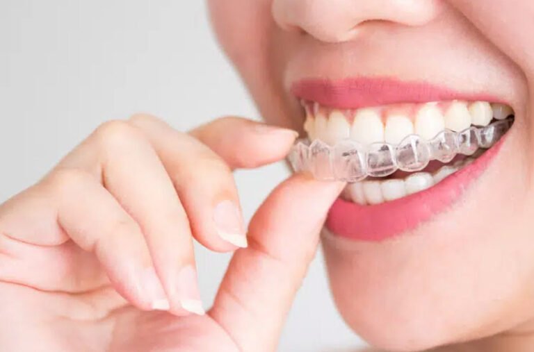 Everything you need to know about Clear Aligners - Upbeat Geek