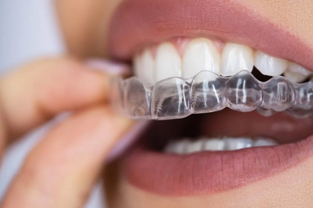 Exploring Innovative Orthodontic Treatments in Surrey