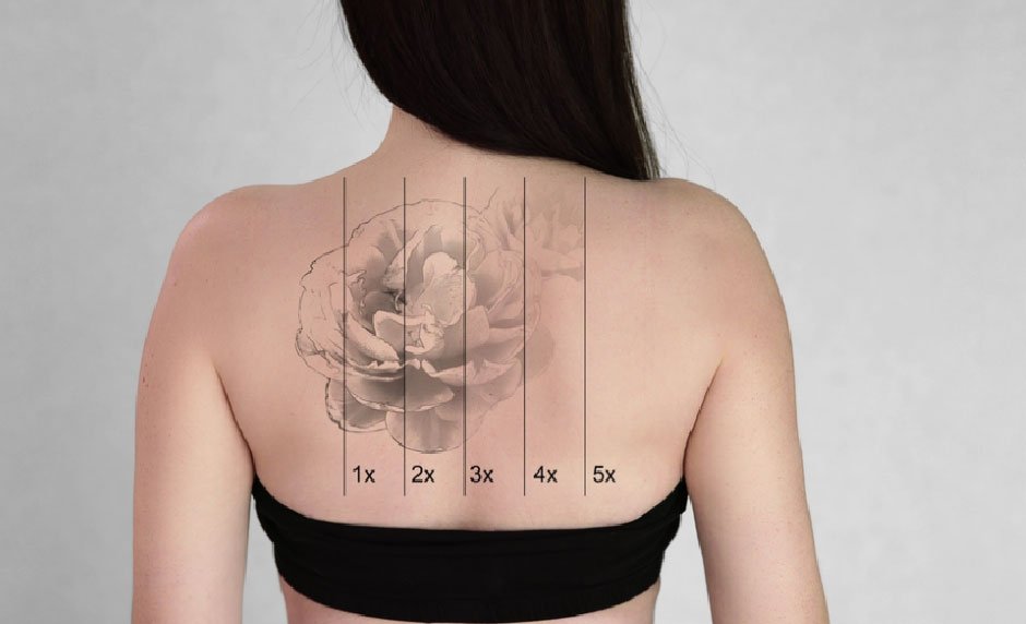 How Long Does It Really Take to Remove a Tattoo