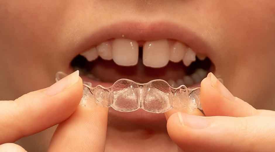 How to Find Affordable Invisalign in Massachusetts Without Sacrificing Quality