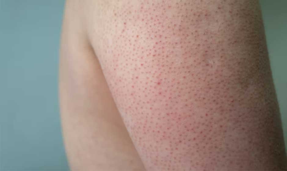 Understanding Keratosis Pilaris