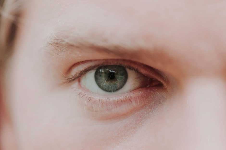 Understanding "Coke Eyes": What Are They?