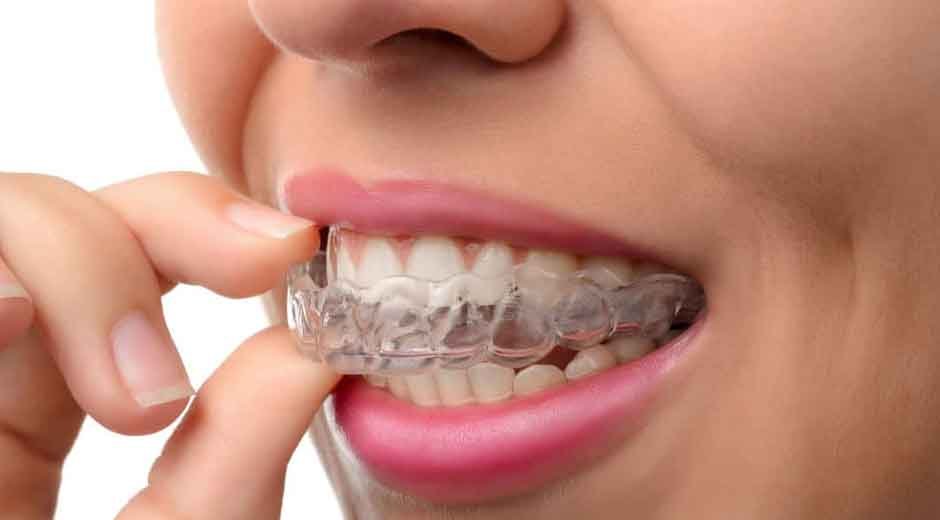 What Kelowna Athletes Gain by Choosing Invisalign Over Braces