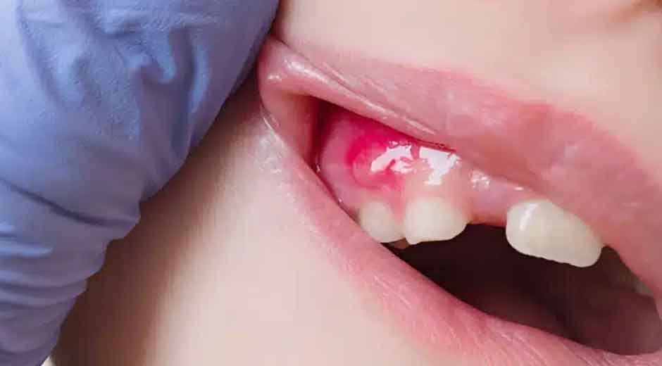 Tooth Infections and Your Health: What Happens if You Delay Treatment