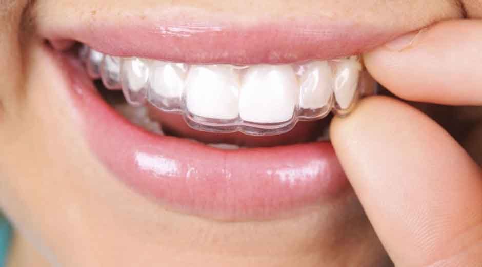 Three Levels of Smile Improvement: Finding Your Perfect Aligner Treatment