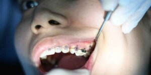 Building Positive Dental Habits During the Teen Years