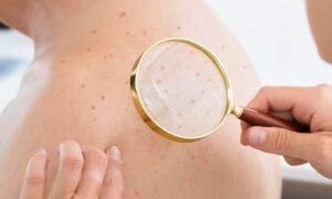 Don't Skip the Skin: Adding Skin Checks to Annual Exams