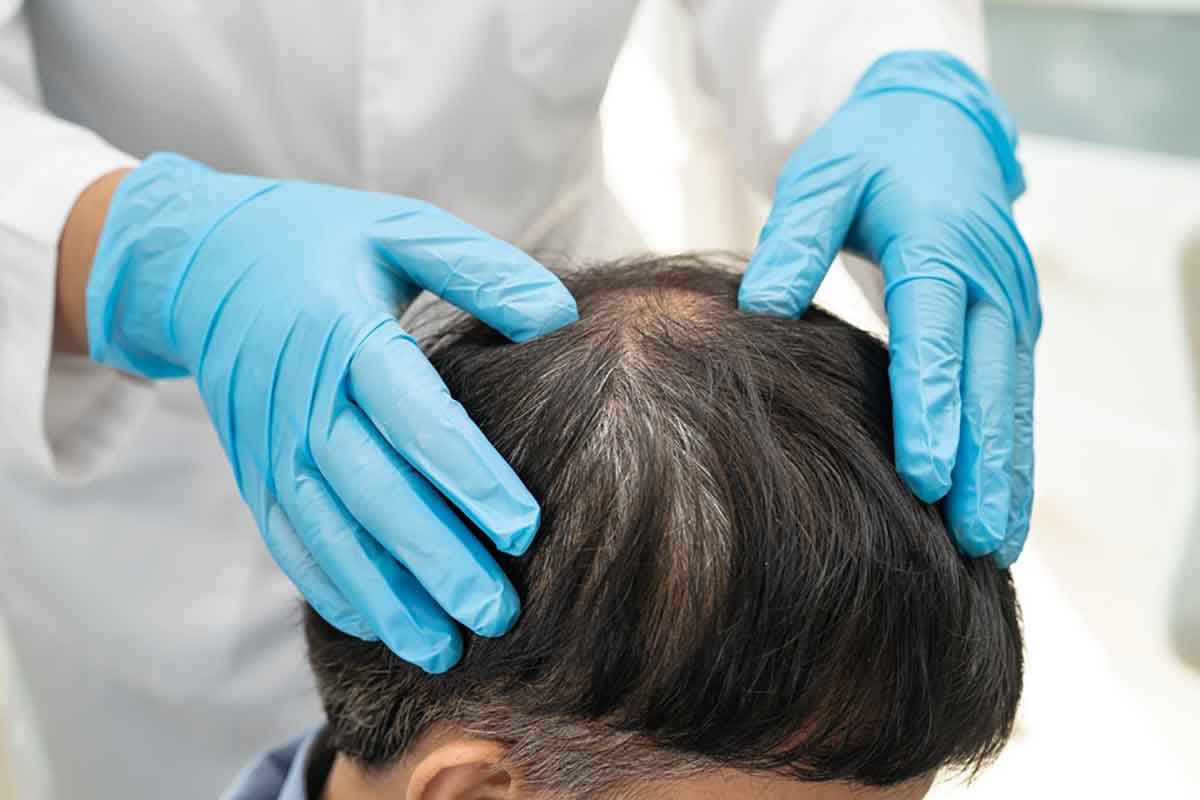 How-to-Choose-the-Right-Men s-Hair-Loss-Treatment-for-Your-Needs