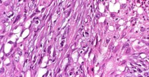 what-to-know-about-the-sarcomatoid-mesothelioma-ce-1