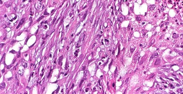 what-to-know-about-the-sarcomatoid-mesothelioma-ce-1